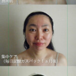 炭酸ガスパック 3カ月経過後の比較写真